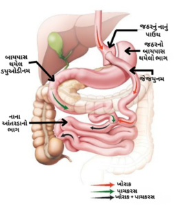 જઠરનો કાપી નાખાયેલો ભાગ અને નવું ગેસ્ટ્રિક સ્લીવ જઠર