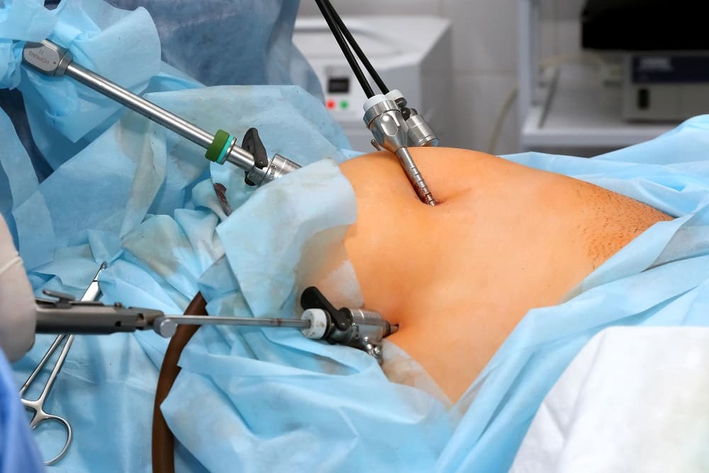 Laparoscopic or minimally invasive AWR