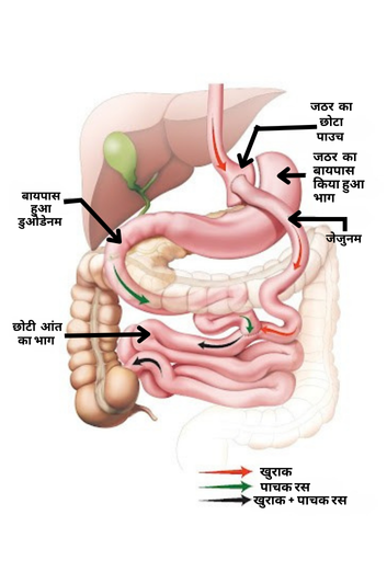 गेस्ट्रिक-बायपास-सर्जरी