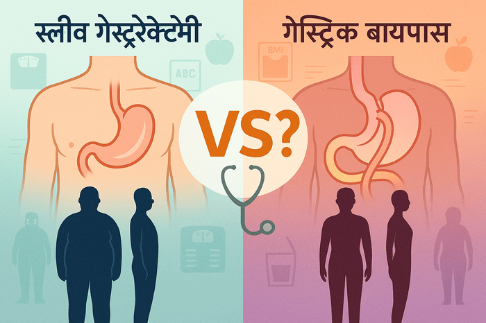 स्लीव गेस्ट्रेक्टोमी या गेस्ट्रिक बायपास