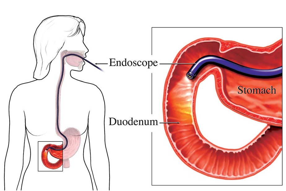 Achalasia Cardia but an important cause o difficulty in