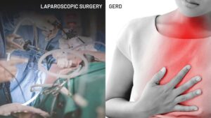 laparoscopic Surgery - GERD