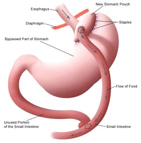 Bariatric Surgery Image