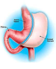 Bariatric Surgery Image