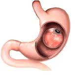 Bariatric Surgery Image