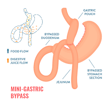 Bariatric Surgery Image