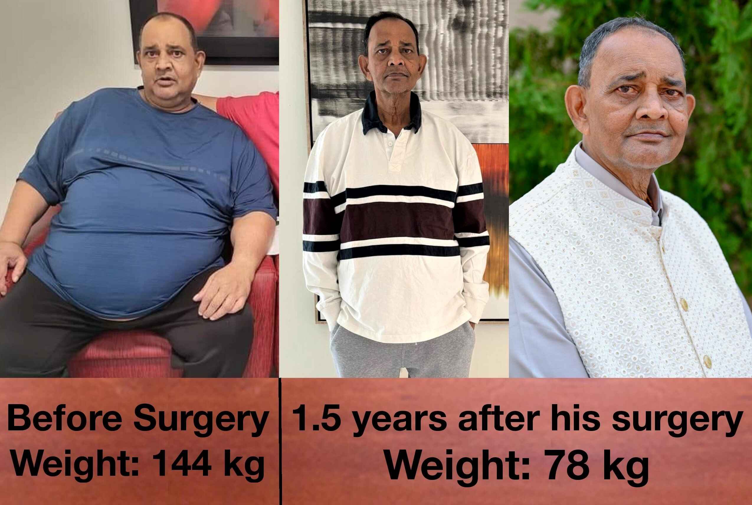 Patient treated for sleeve gastrectomy in ahmedabad, india