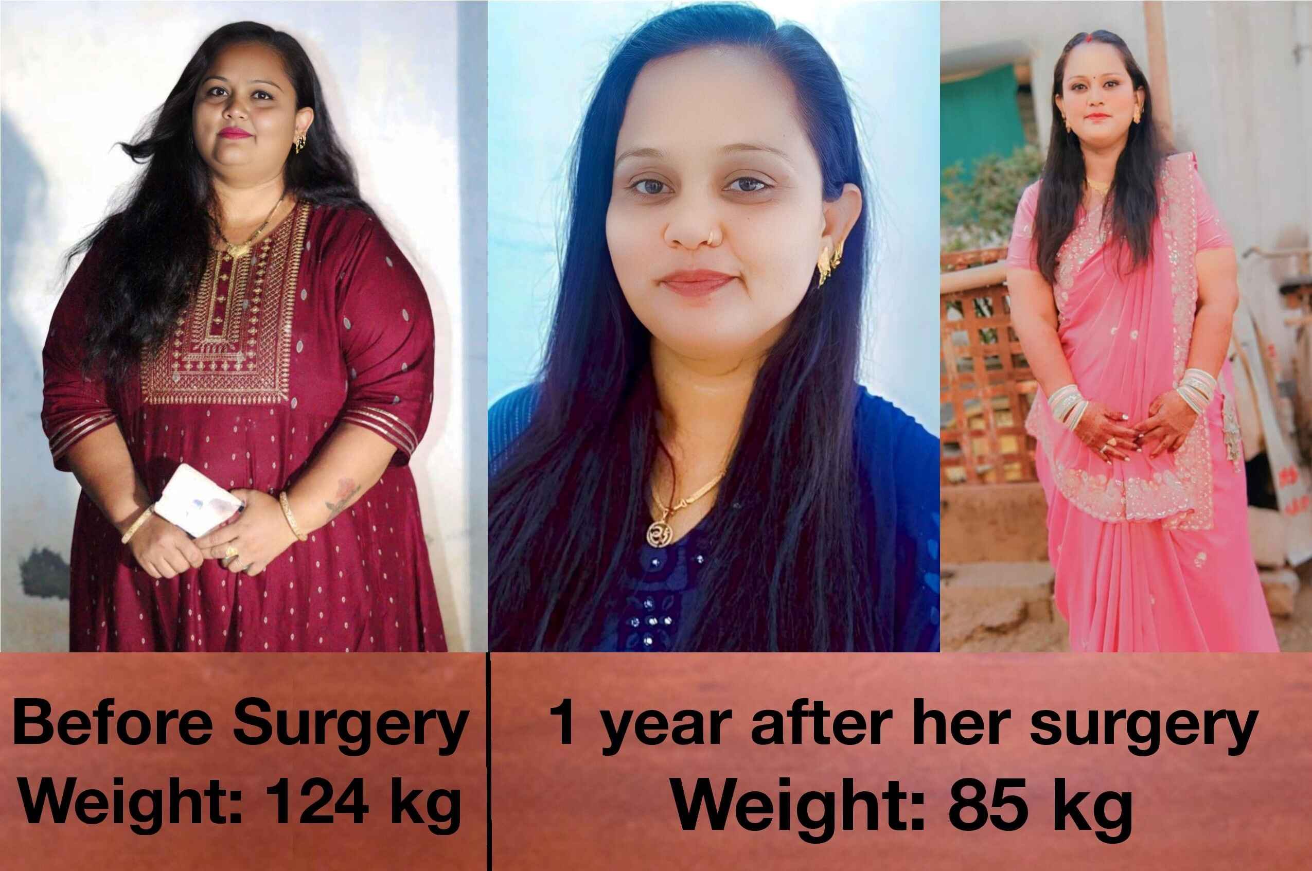 Patient Treated by best bariatric surgeon in ahmedabad, gujarat, india