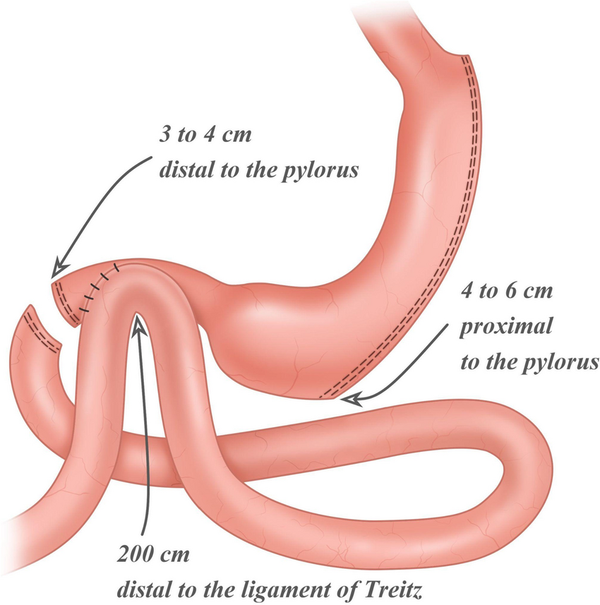Bariatric Surgery Image